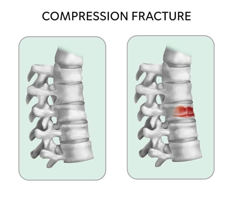 Compression Fractures - SpineCare Singapore